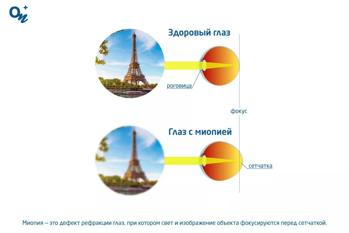 Что такое миопия (близорукость) и как ее лечить — блог медицинского центра  ОН Клиник