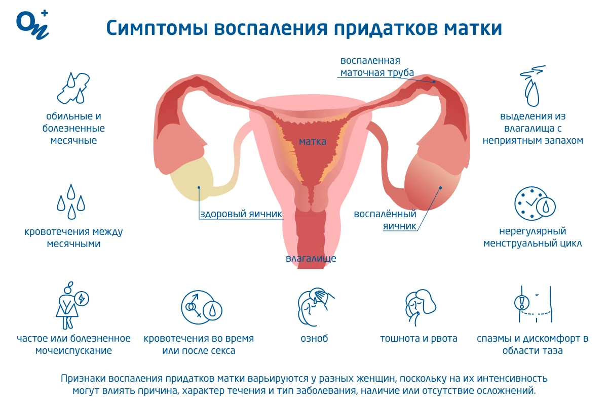 Пиосальпинкс: причины, симптомы и лечение