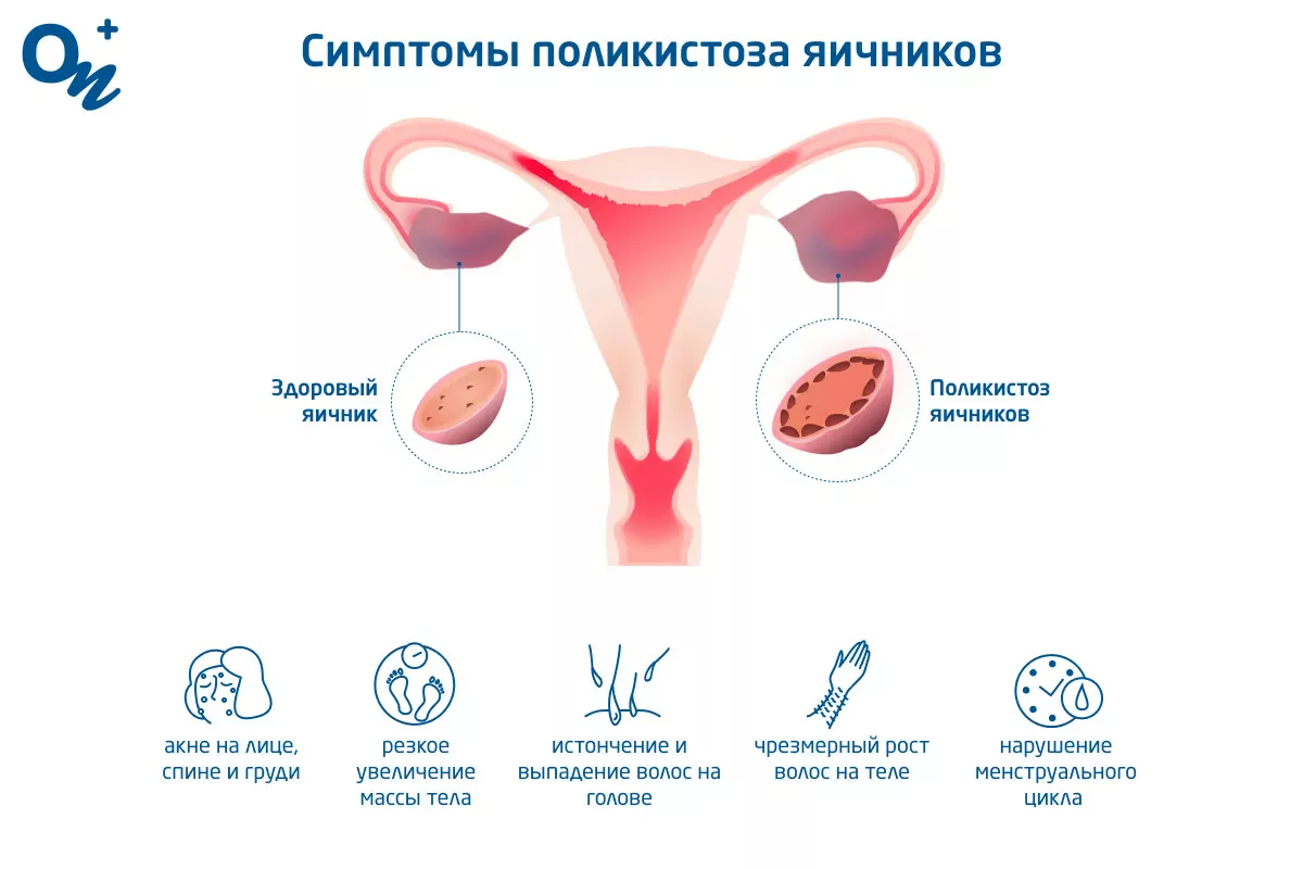 Симптомы и способы лечения поликистоза яичников (СПКЯ) — блог медицинского  центра ОН Клиник