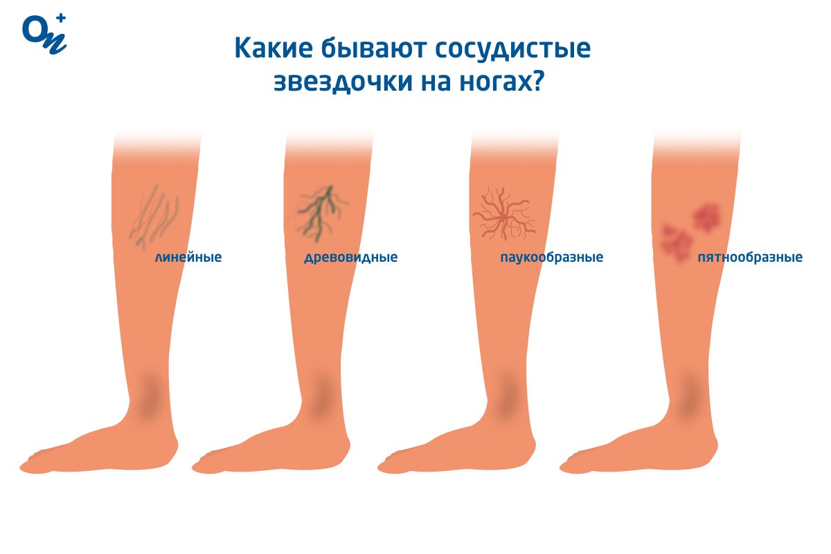 Ультразвуковое дуплексное сканирование - Лечение варикоза в Пензе. Варикоз вен вылечить просто!