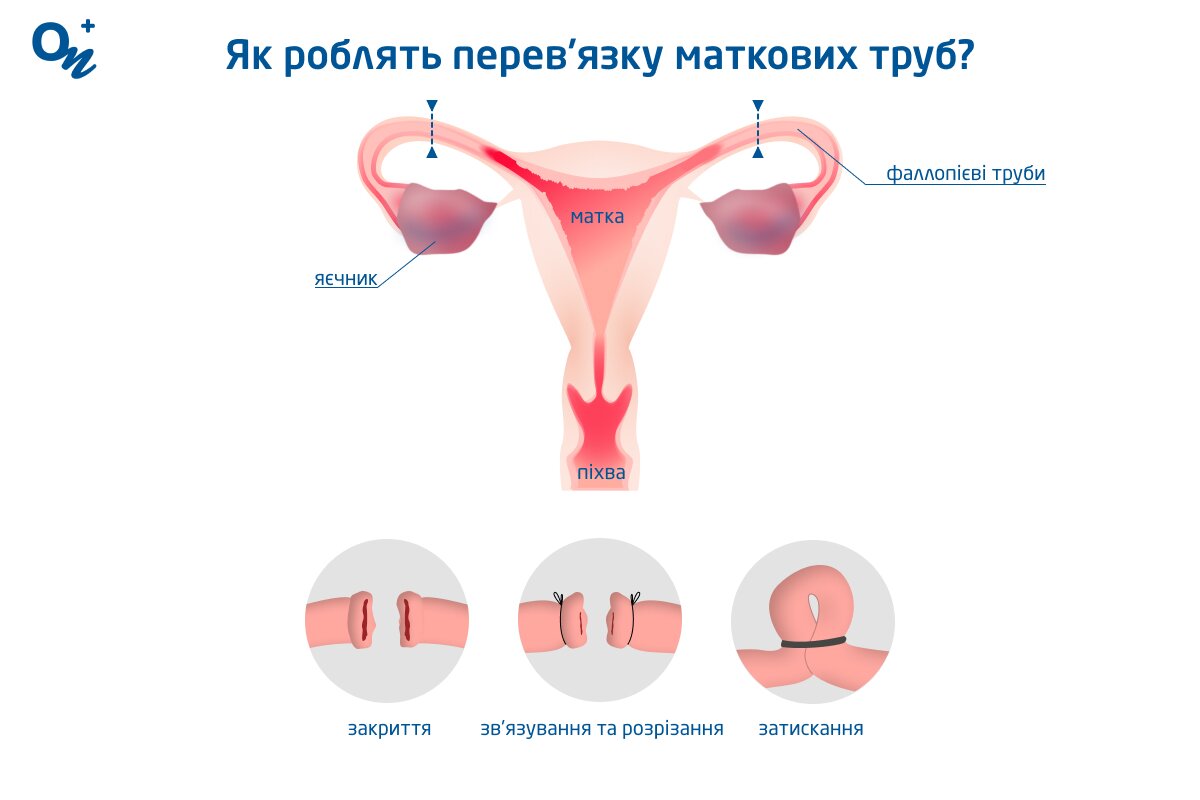Перев’язка маткових труб