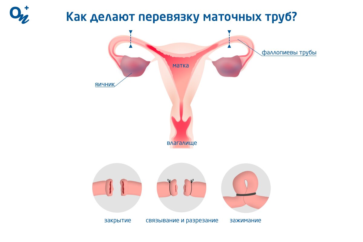 Как забеременеть женщине с перевязанными маточными трубами: главное о женской стерилизации