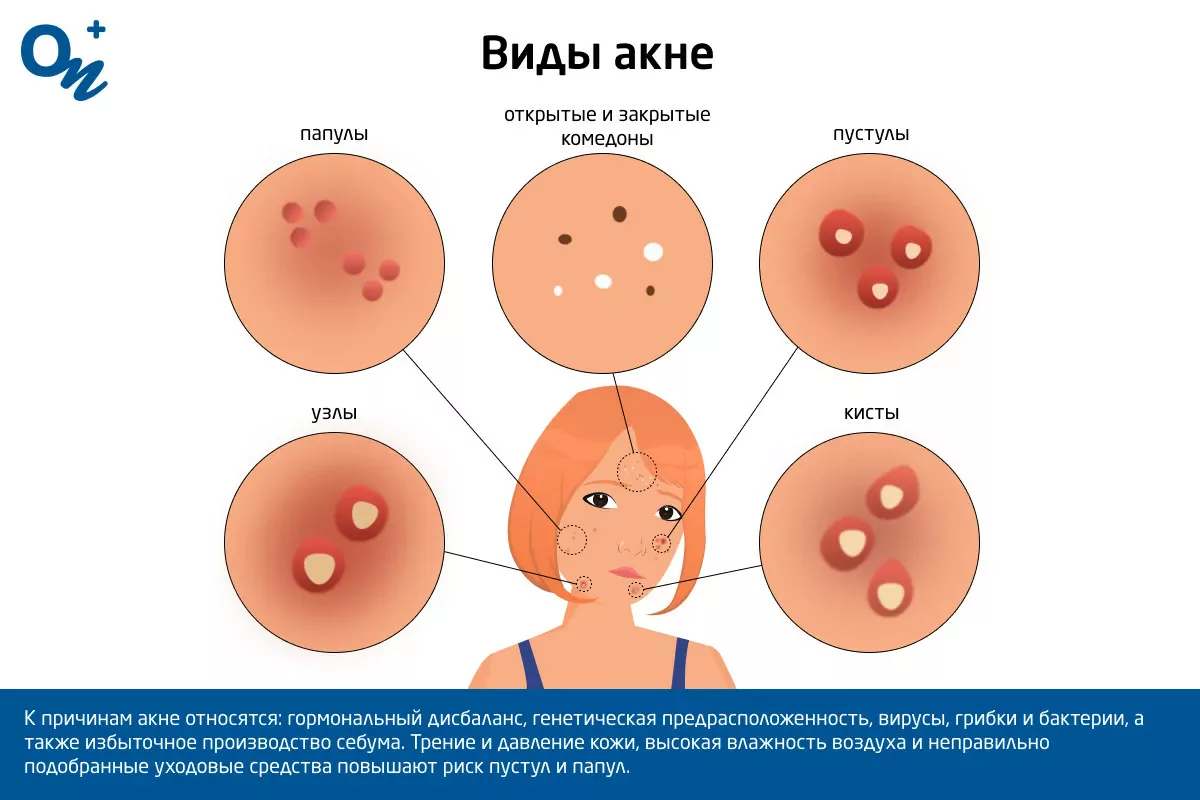 Как избавиться от бородавок?