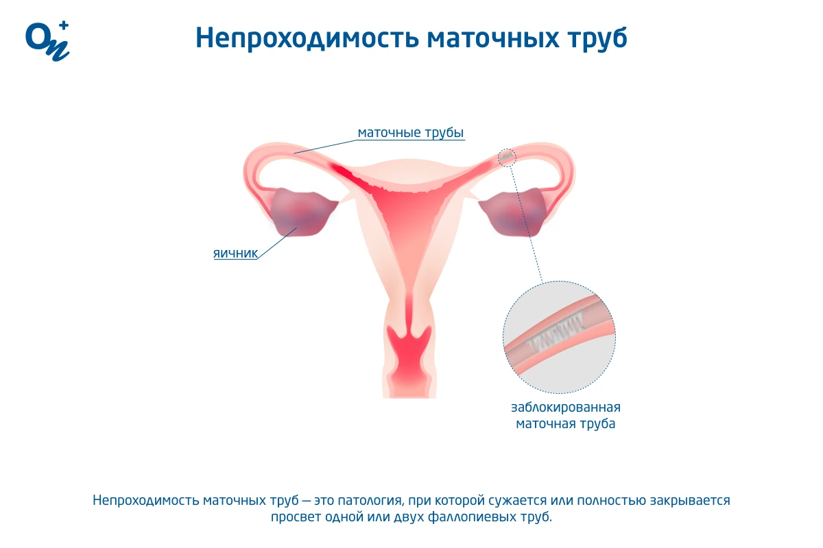 Разделение спаек и лечение непроходимости маточных труб