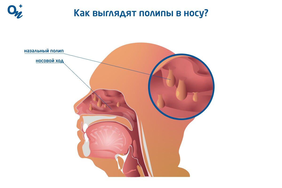 Носовое кровотечение: причины, симптомы, методы лечения