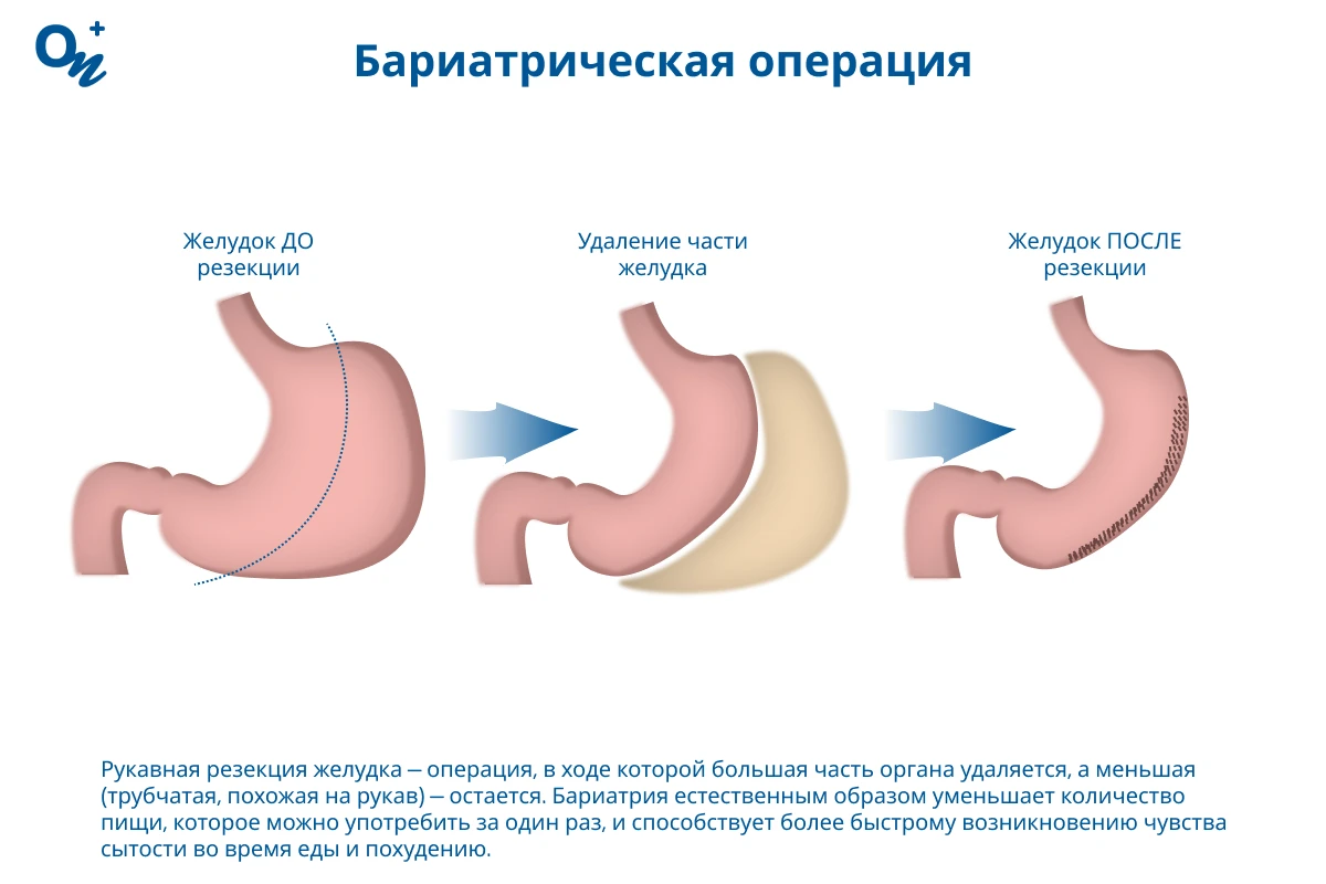 Бариатрическая операция