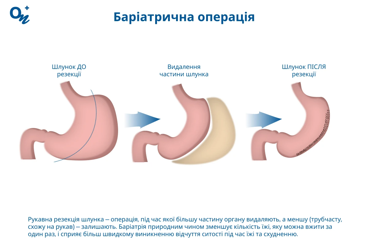 Баріатрична операція