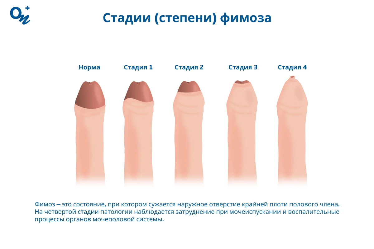 секс при детях Фимоз и синехии у детей — блог медицинского центра ОН Клиник