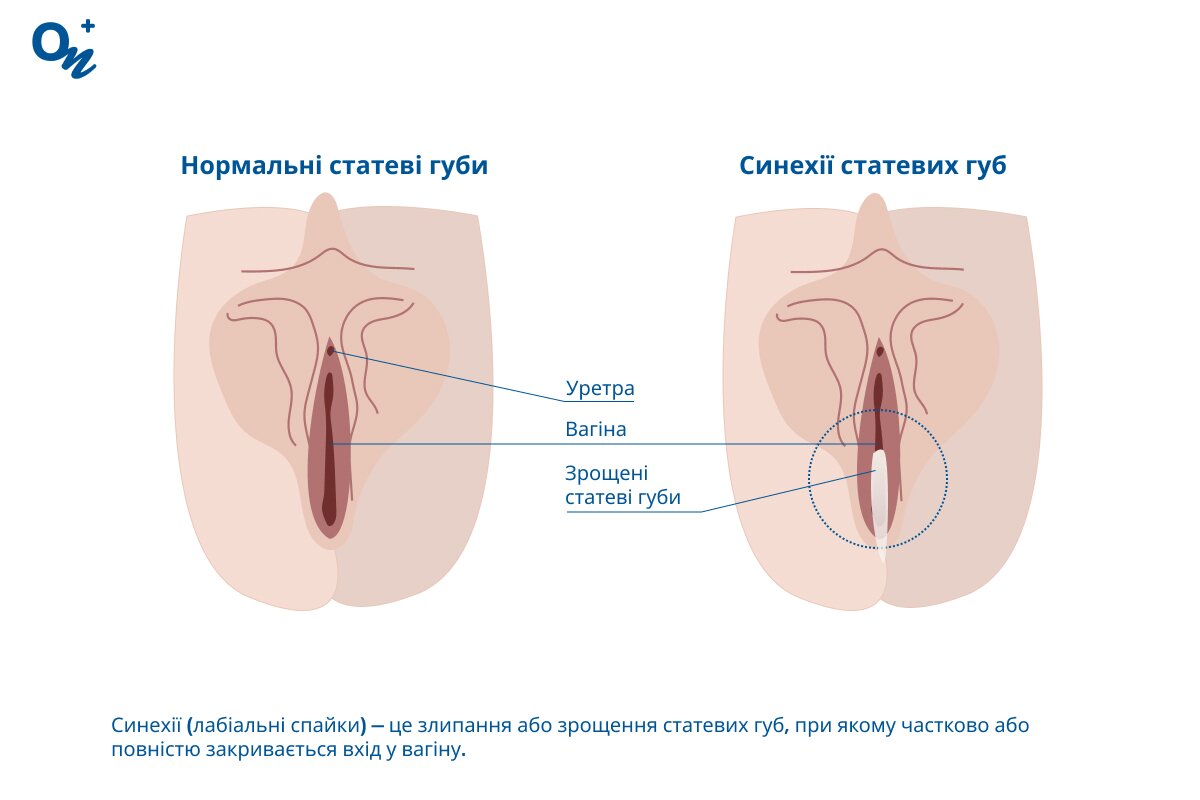 Синехії статевих губ