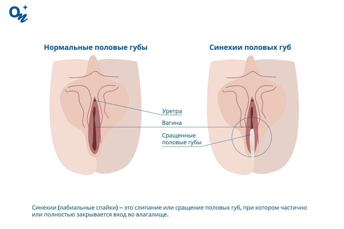 Фимоз и синехии у детей — блог медицинского центра ОН Клиник