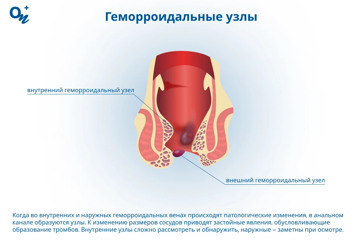 Геморроидальные узлы