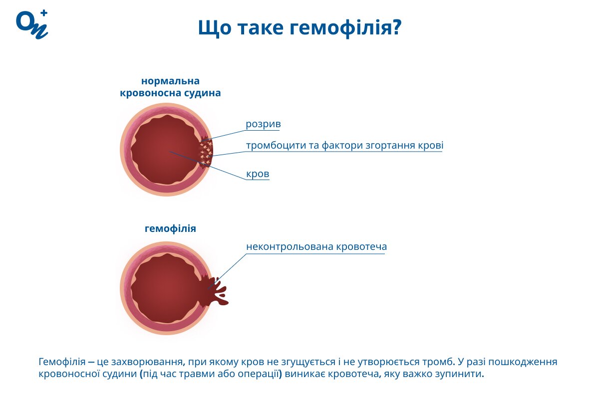 Що таке гемофілія?