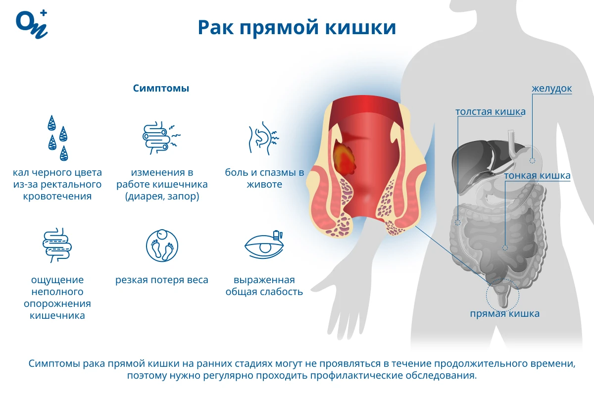 Рак прямой кишки