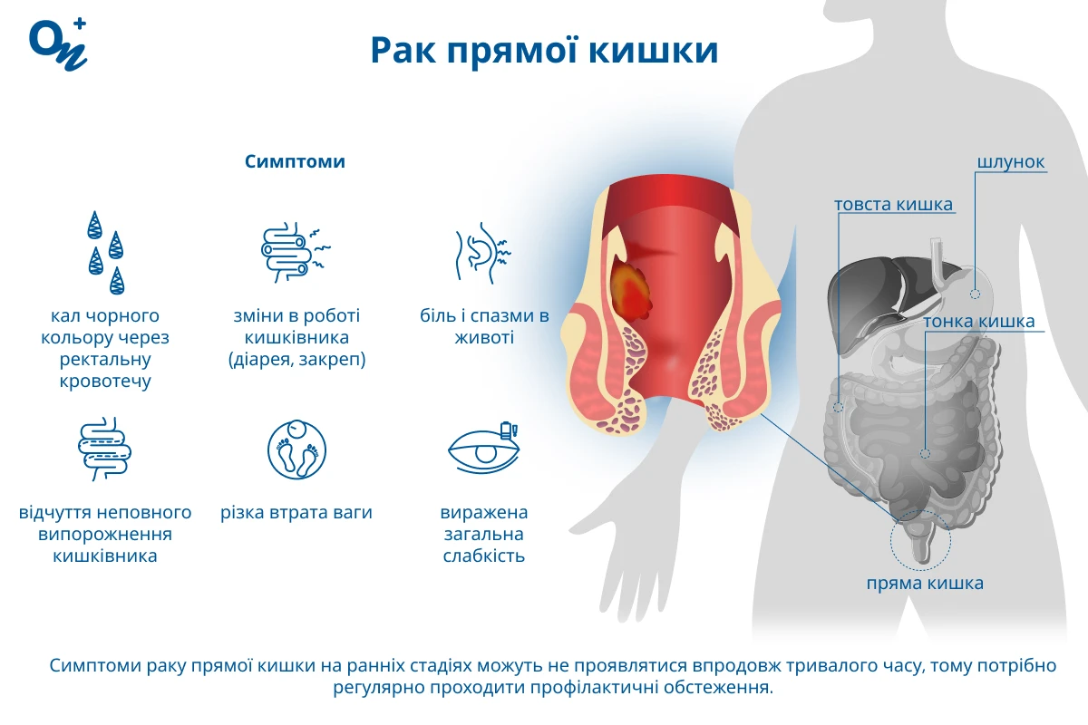 Рак прямої кишки