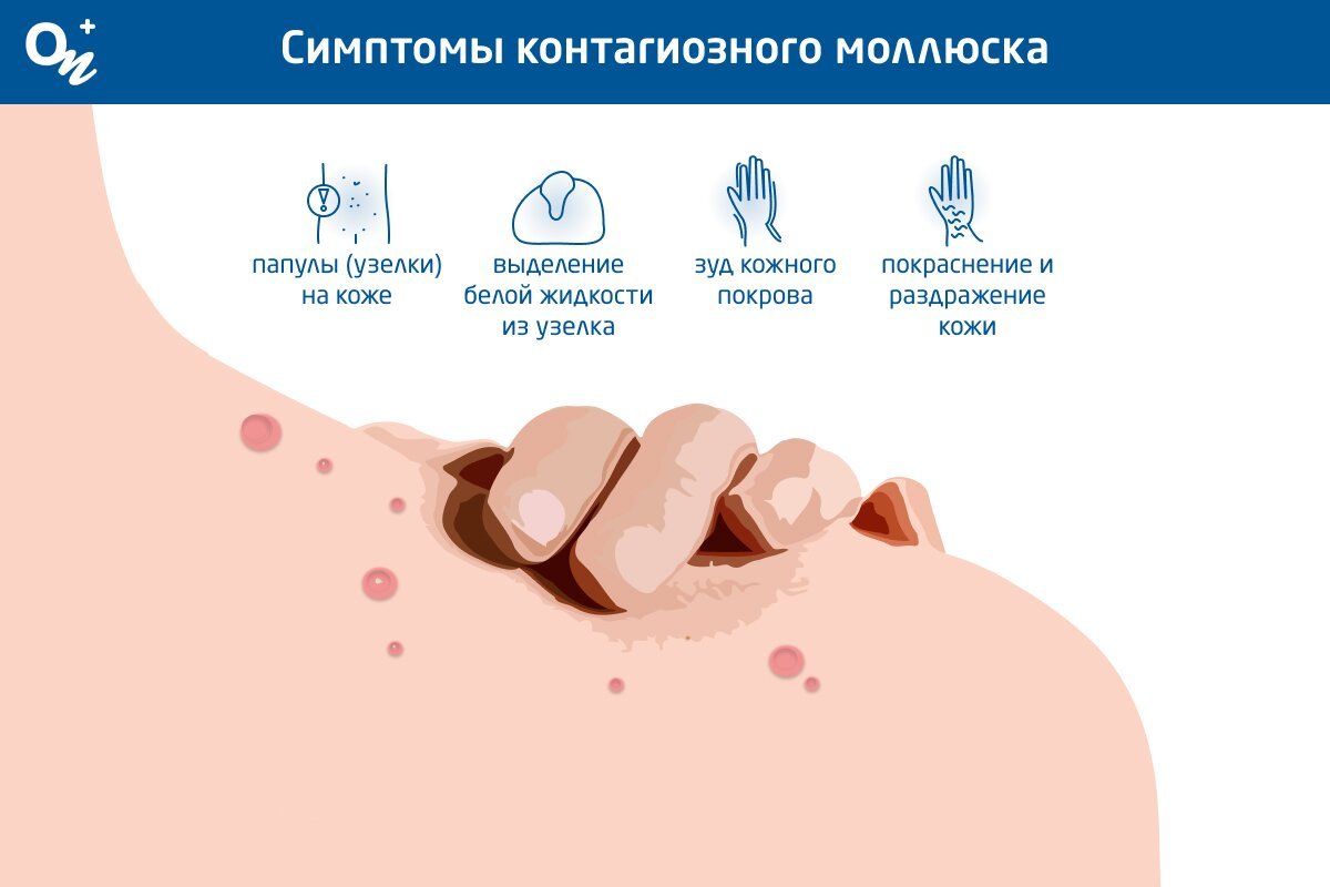 Симптомы контагиозного моллюска