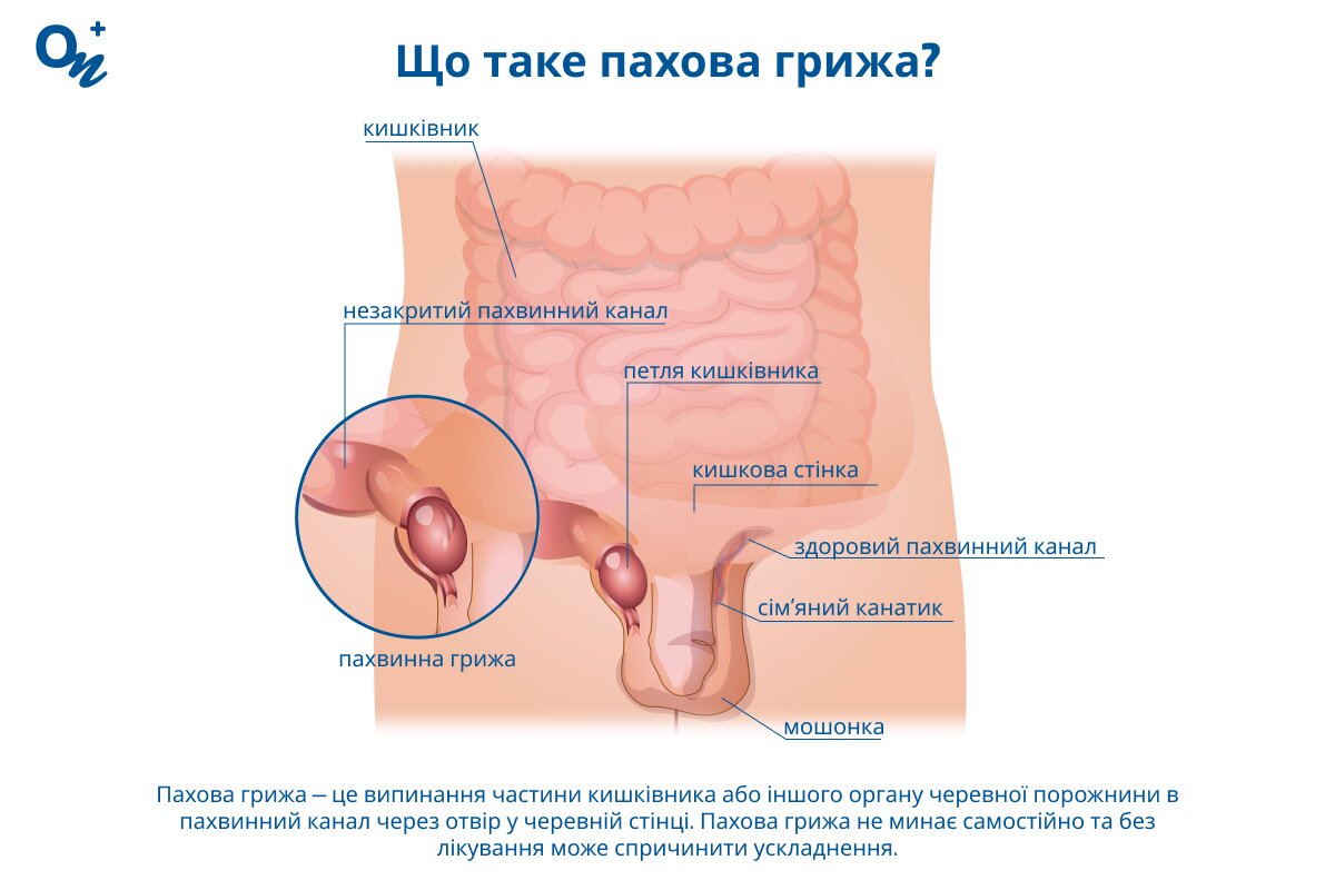 Як виглядає пахова грижа?