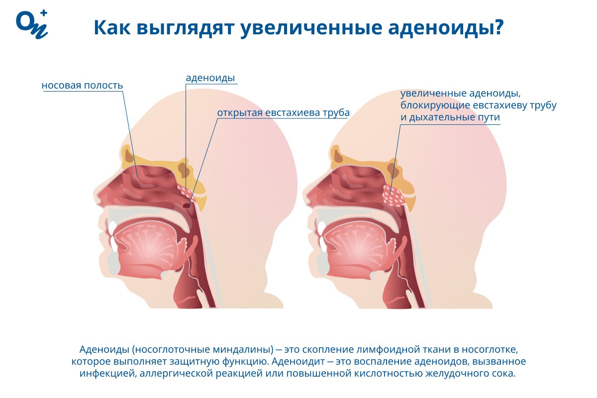 Как выглядят увеличенные аденоиды?