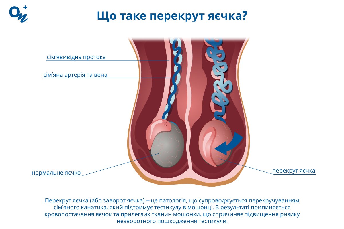 Як виглядає перекрут яєчка?