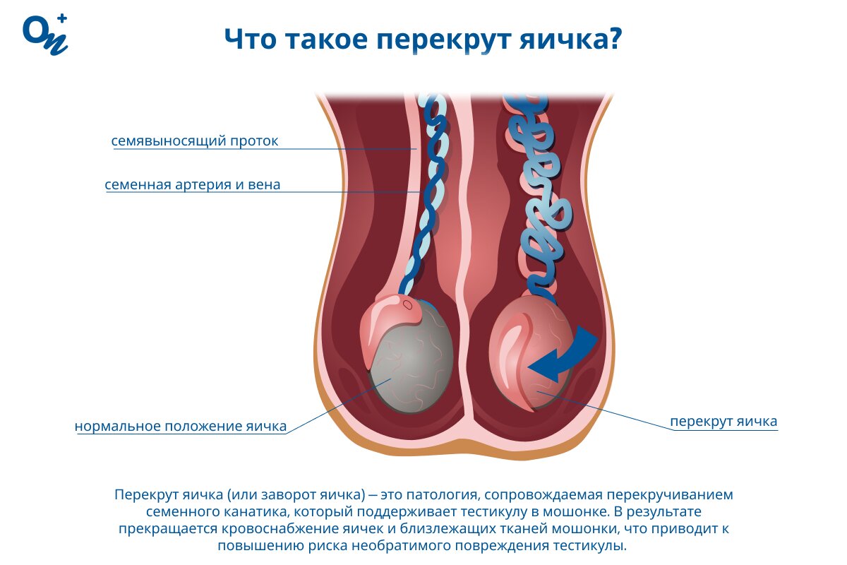 осмотр мужских яичек Какие симптомы указывают на перекрут яичка — блог медицинского центра ОН  Клиник