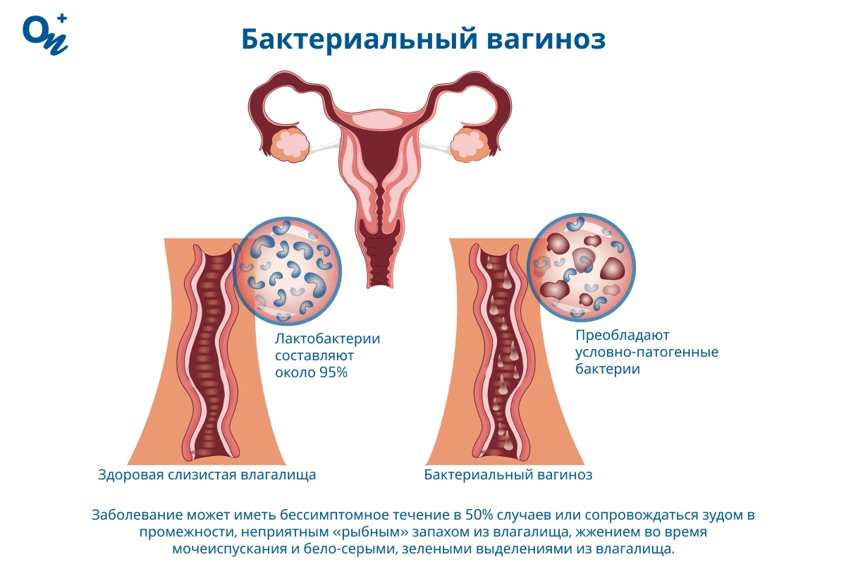 Бактериальный вагиноз