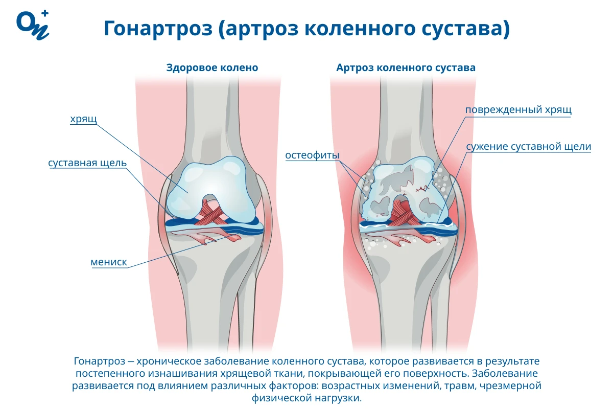 Гонартроз (артроз коленного сустава)