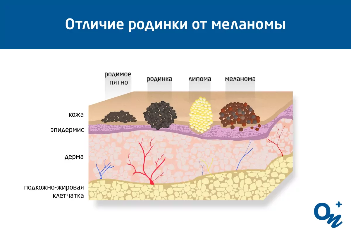 Странный прыщ на родинке