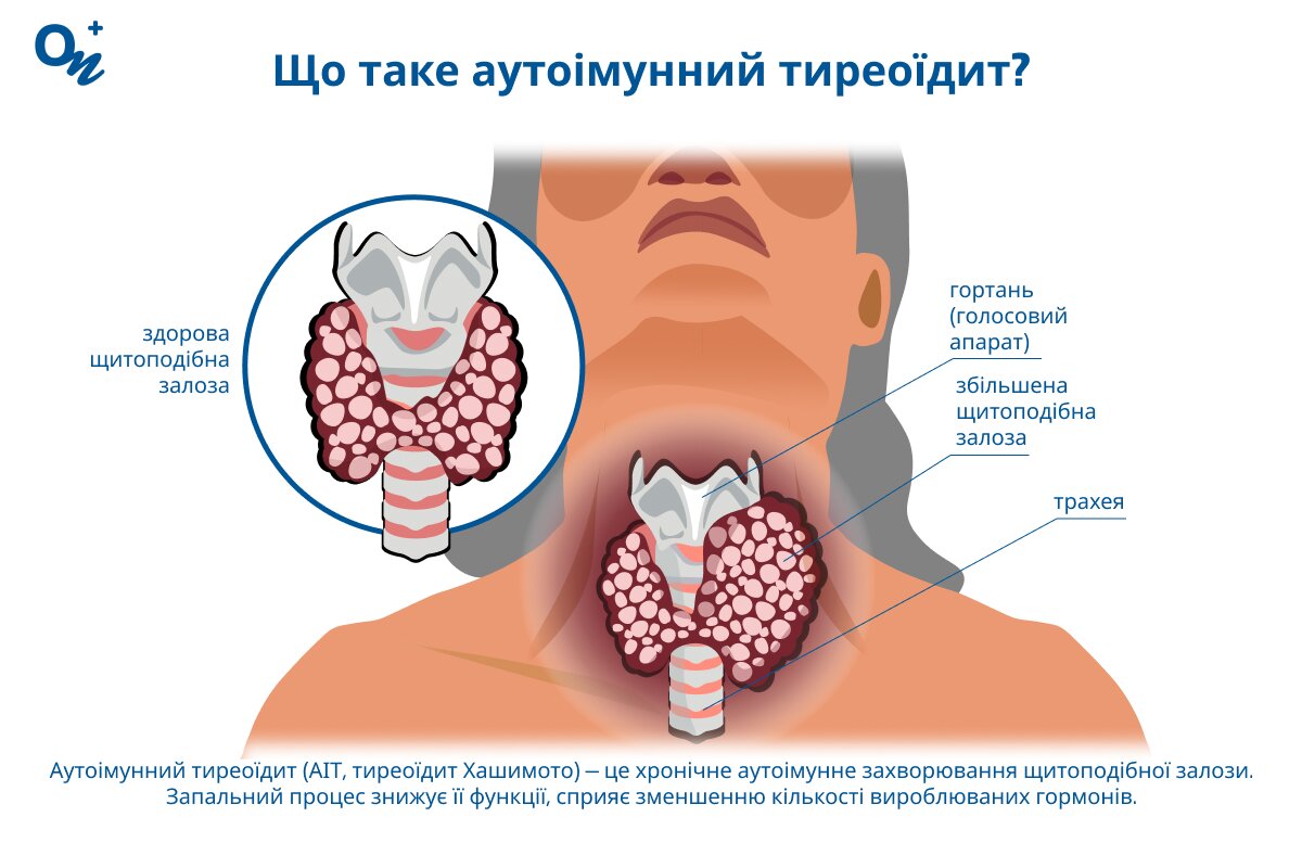 Що таке аутоімунний тиреоїдит (тиреоїдит Хашимото)?