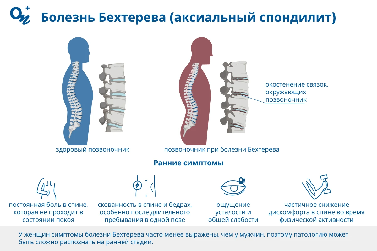 Болезнь Бехтерева