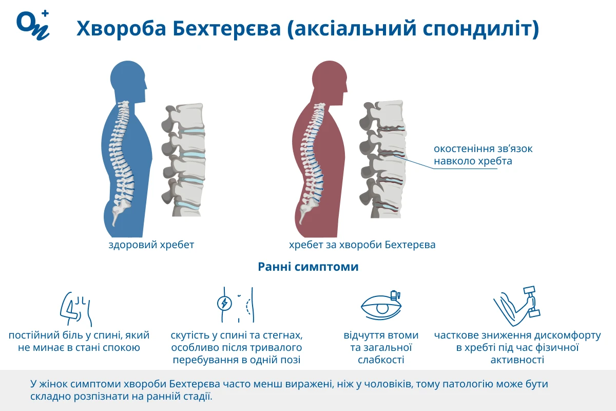 Хвороба Бехтерєва