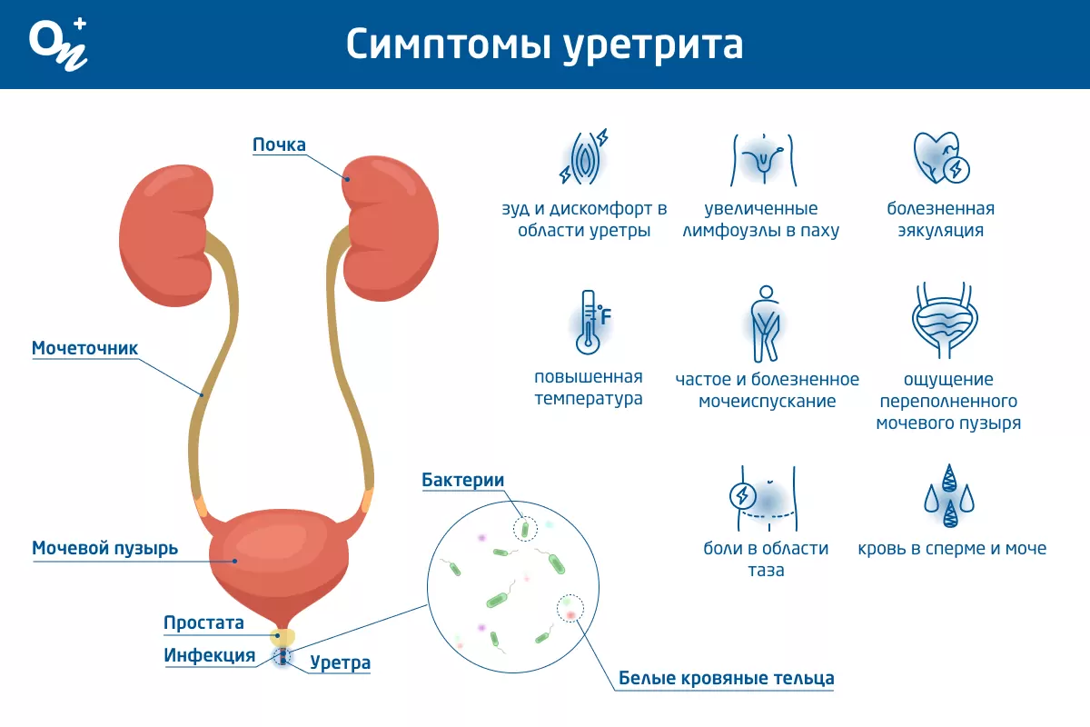 Уретрит у женщин