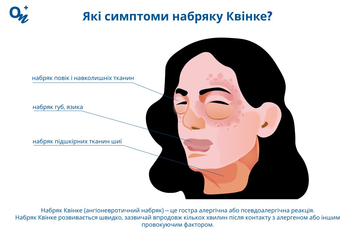Які симптоми набряку Квінке?