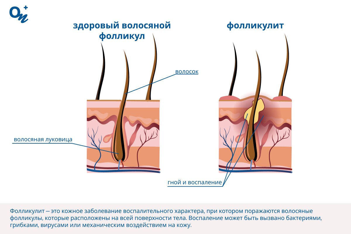 Как выглядит фолликулит?