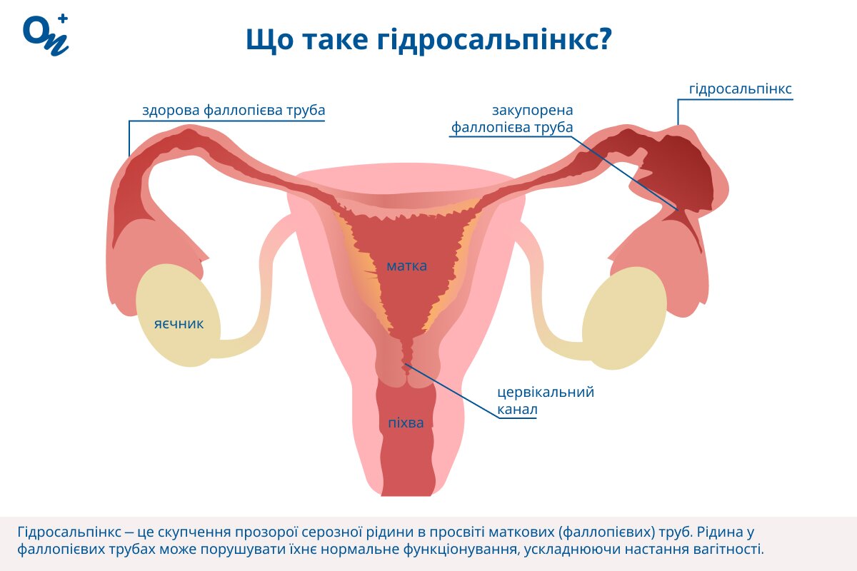 Як виглядає гідросальпінкс?