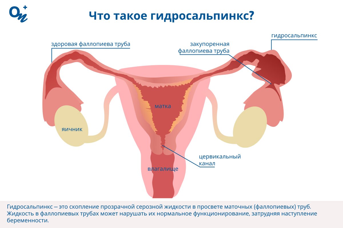 Вскрытие беременных 