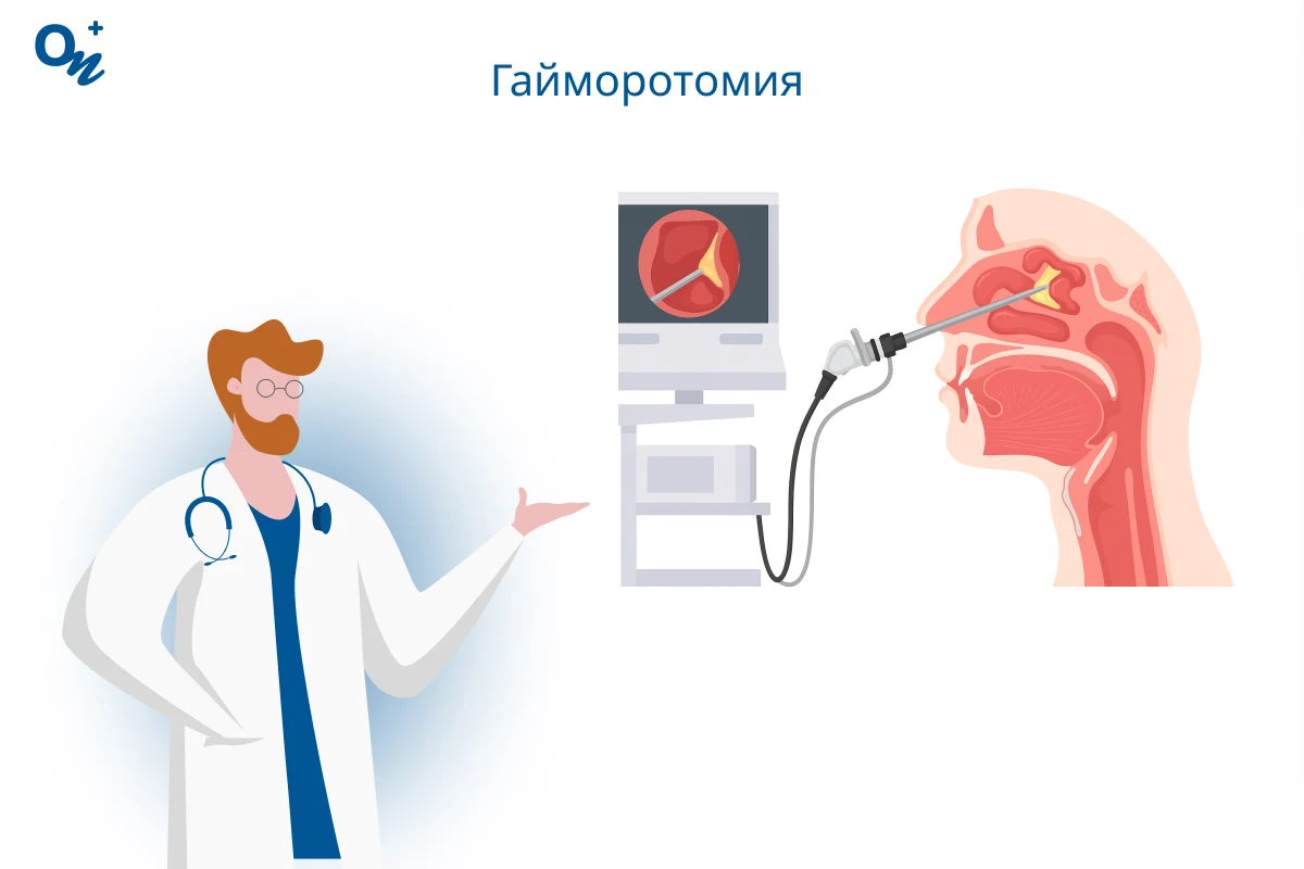 Гайморотомия
