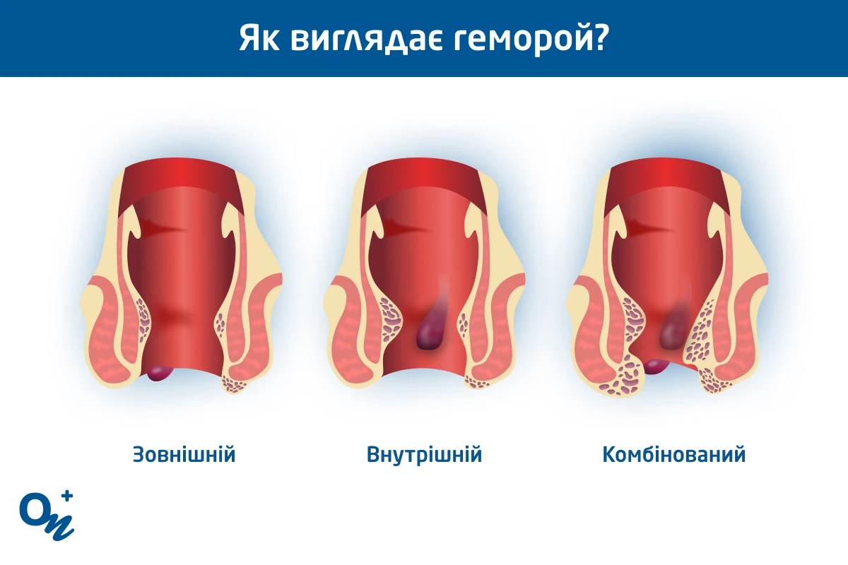внутрішній і зовнішній геморой