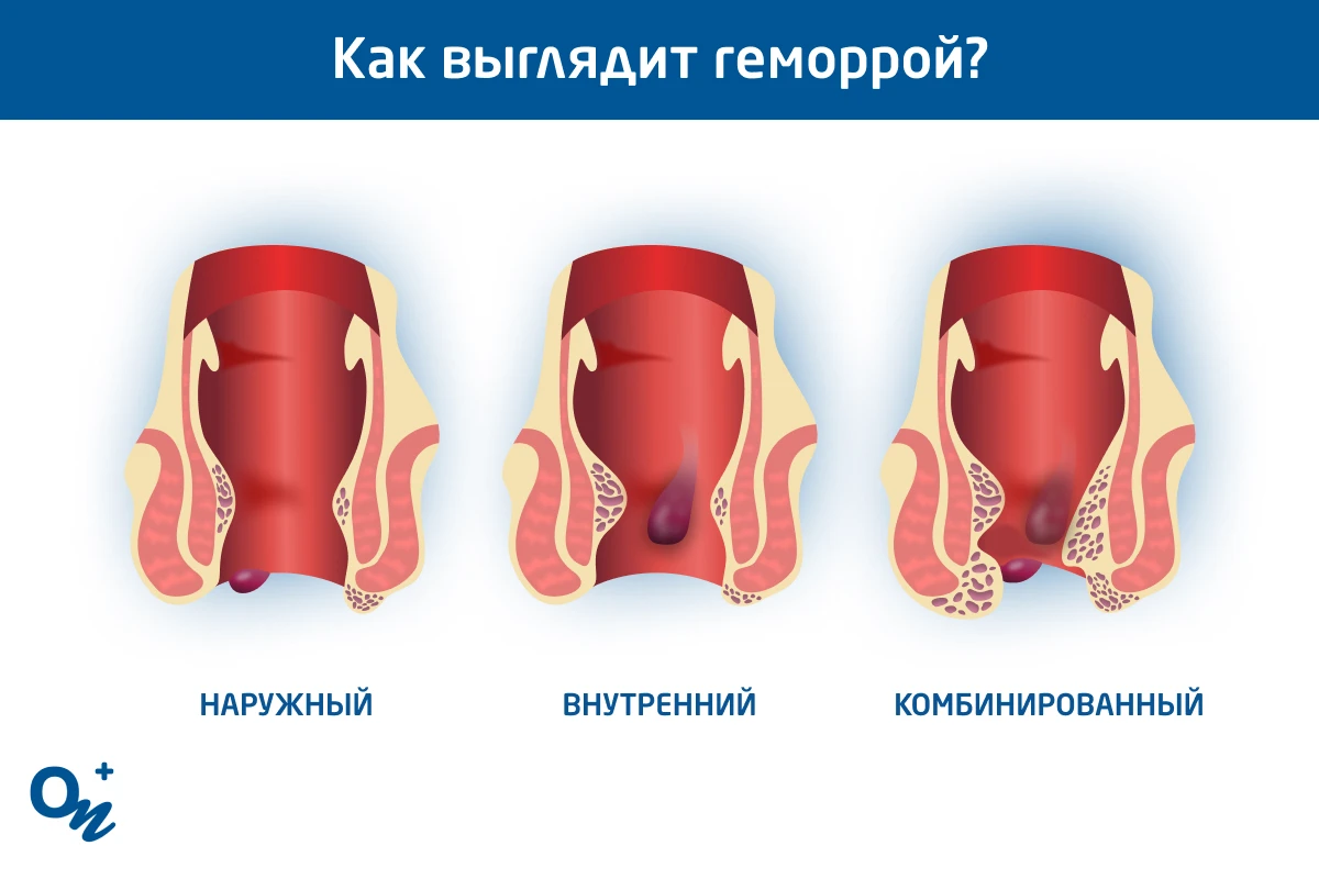 внутренний и внешний геморрой