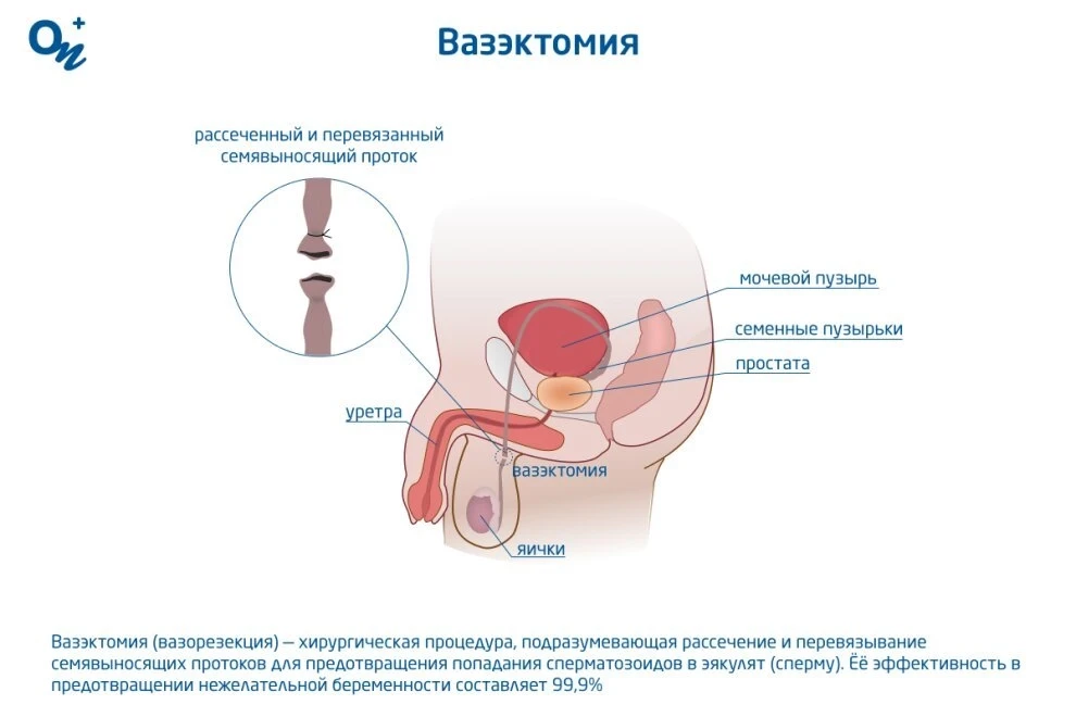 Вазэктомия (вазорезекция, хирургическая контрацепция для мужчин) в Николаеве