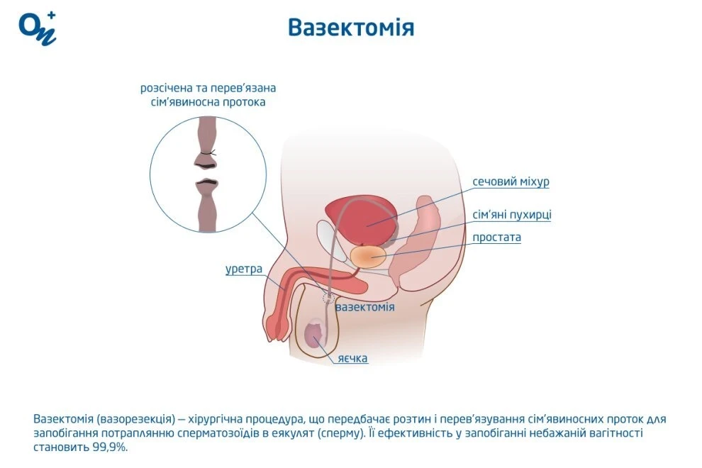 Вазектомія (вазорезекція, хірургічна контрацепція для чоловіків) у Миколаєві