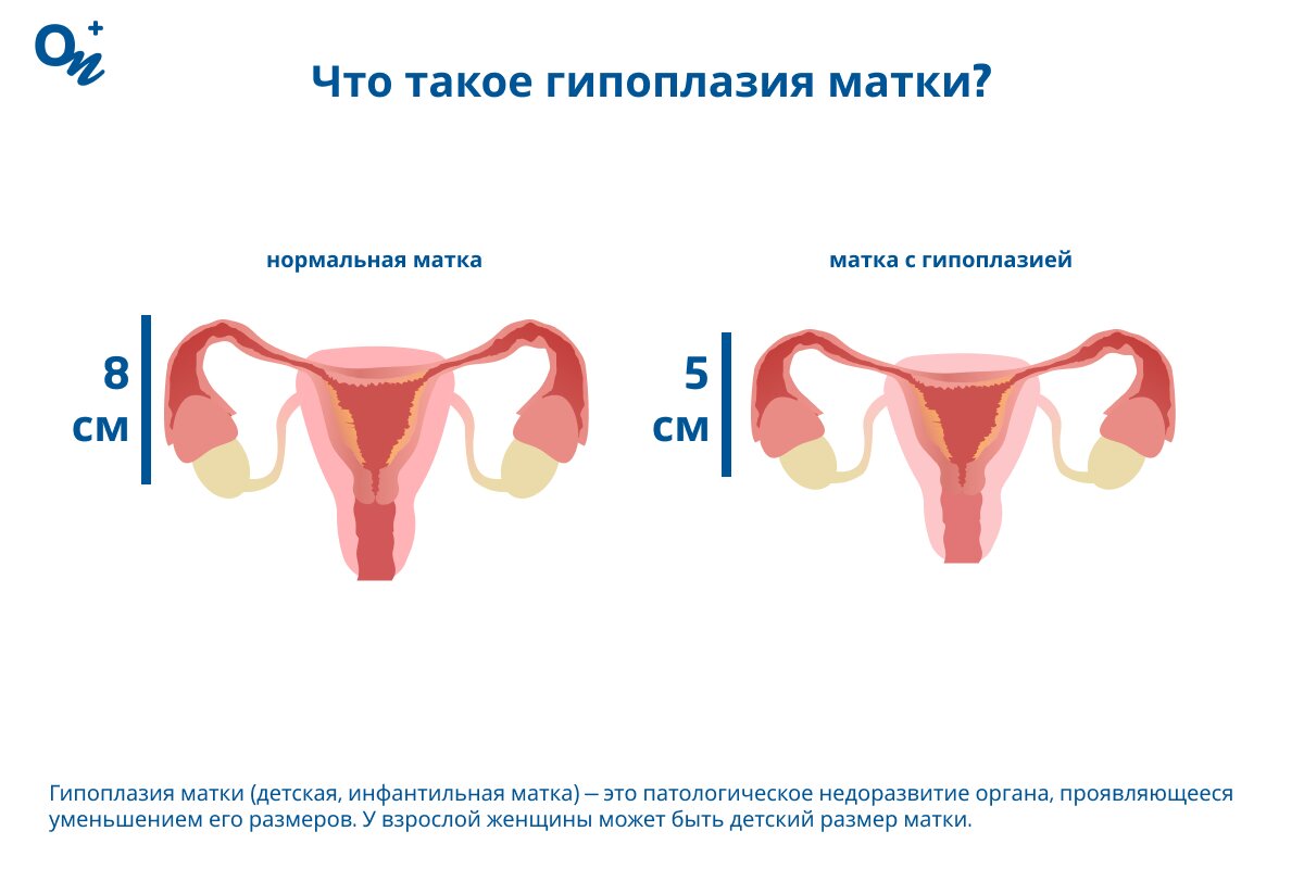 Что такое гипоплазия матки?
