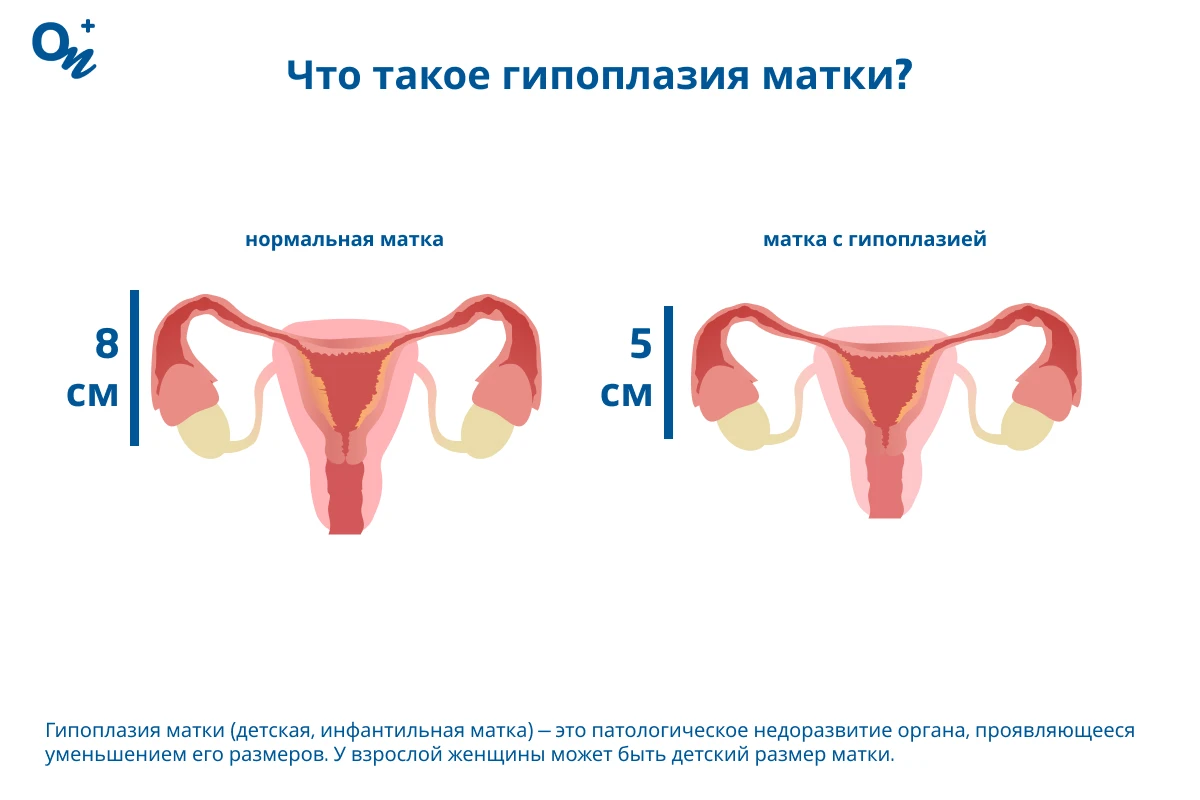 Детская вагина Почему бывает гипоплазия матки и эндометрия и можно ли забеременеть при  данных патологиях— блог медицинского центра ОН Клиник