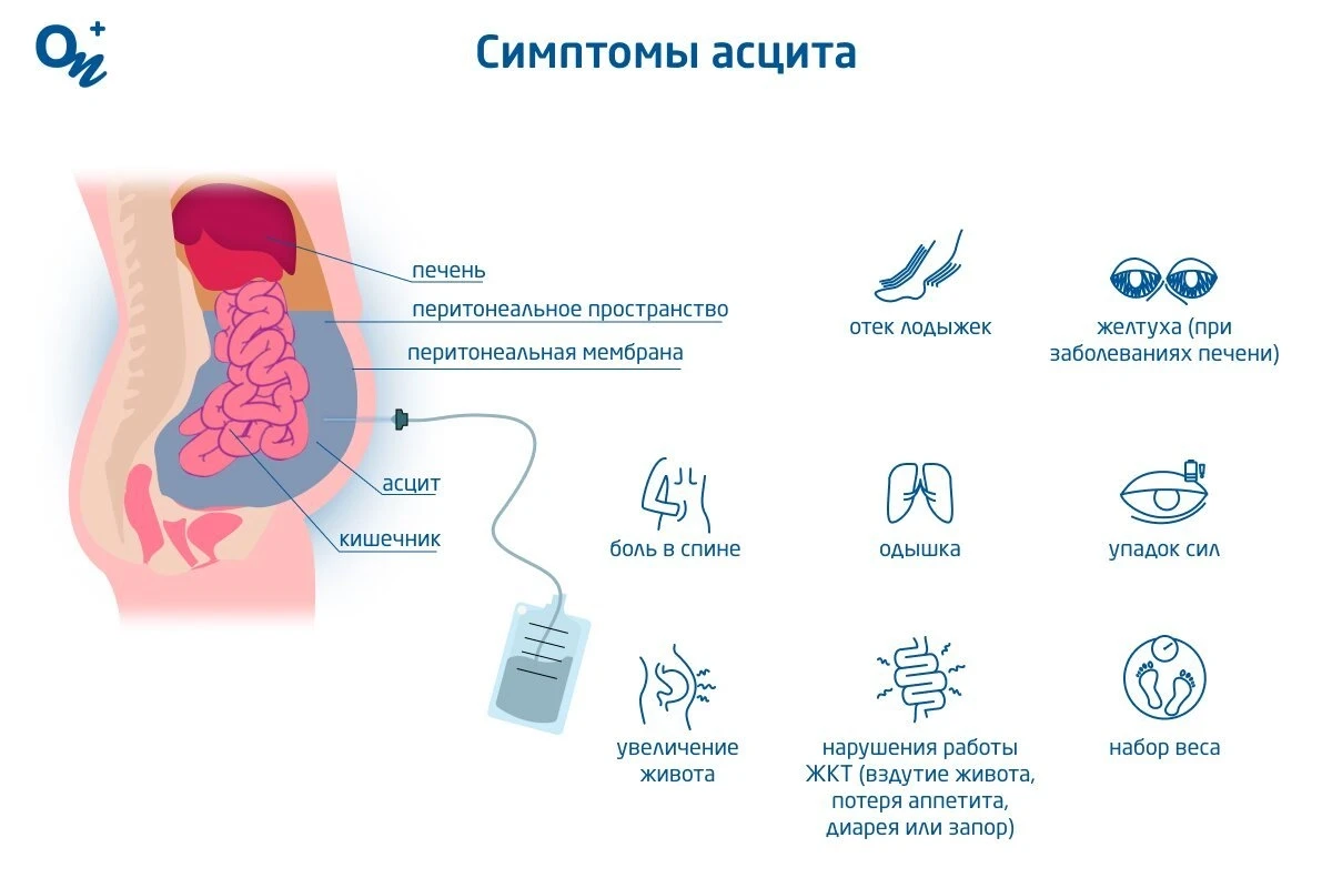 Симптомы асцита