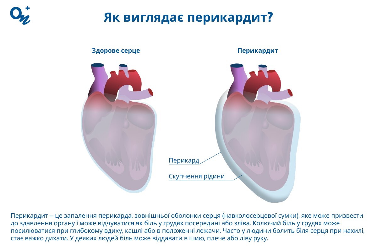 Які симптоми перикардиту?