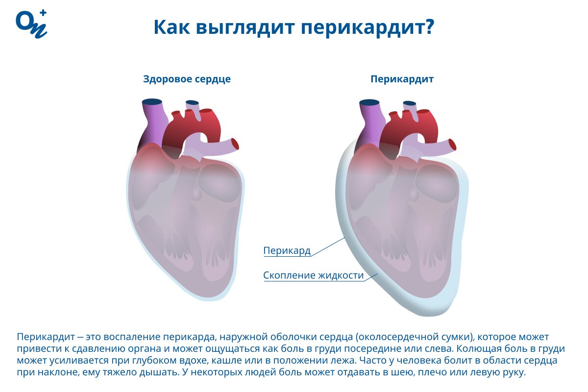 Какие симптомы перикардита?