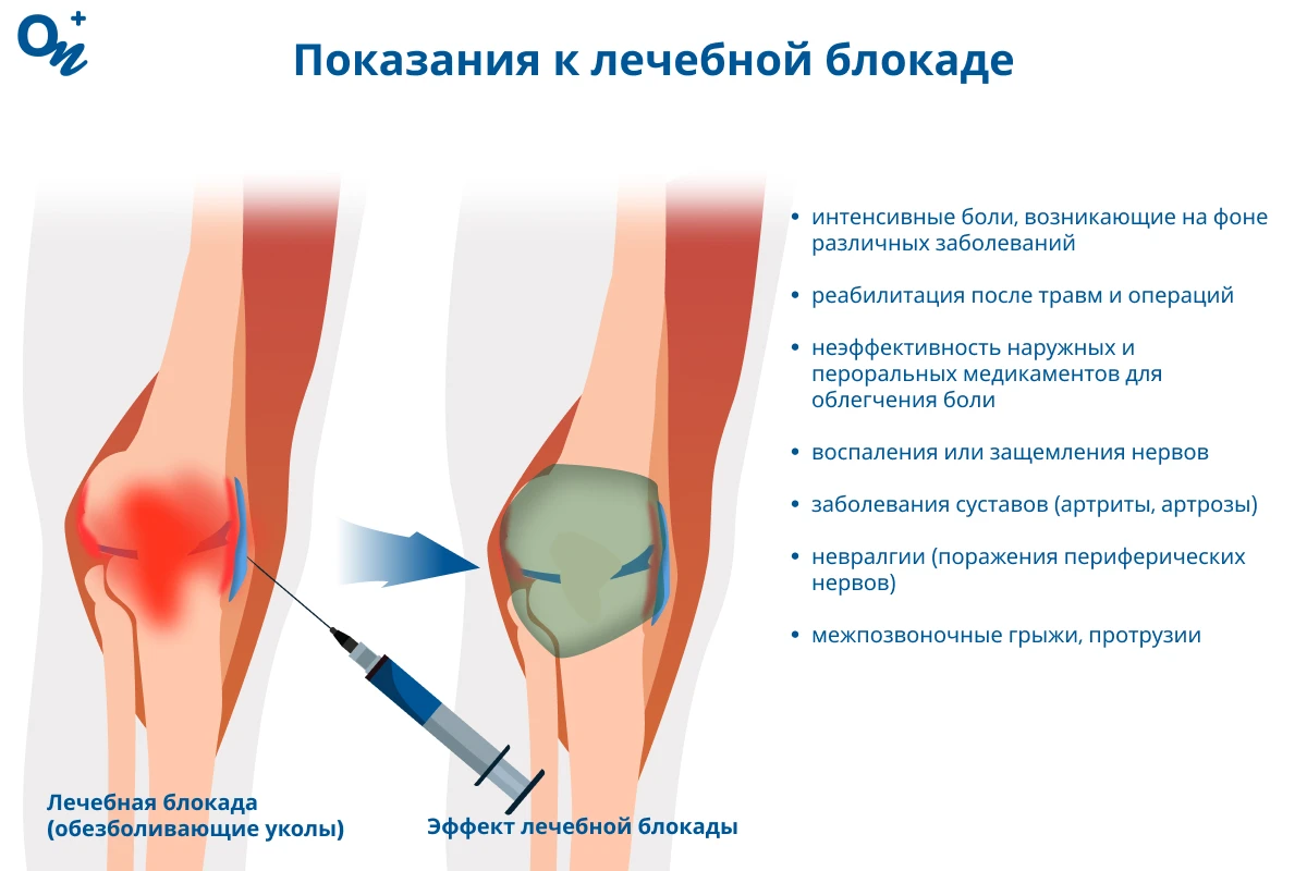 Показания к лечебной блокаде