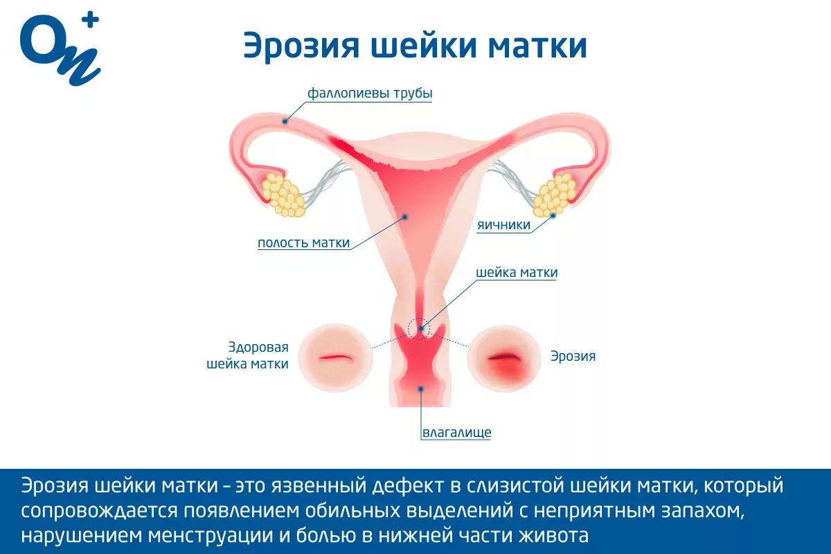 секс после прижигания эрозии - ответов на форуме 930-70-111-80.ru ()