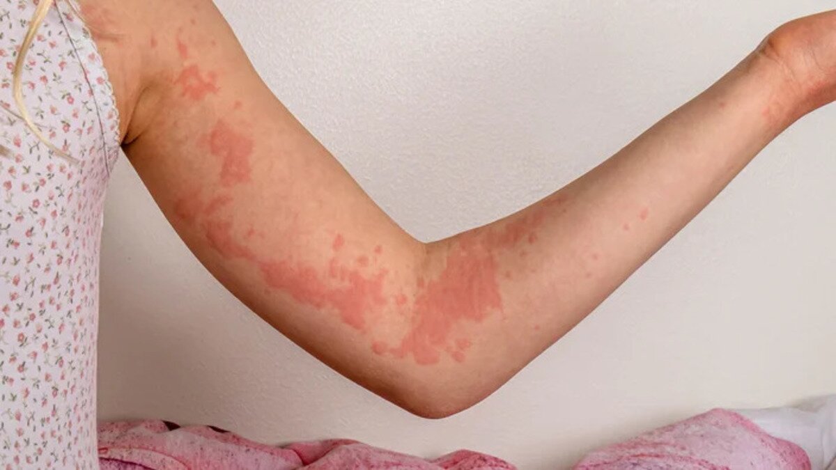 Алергія у дитини