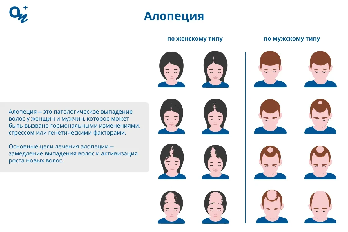 Алопеция