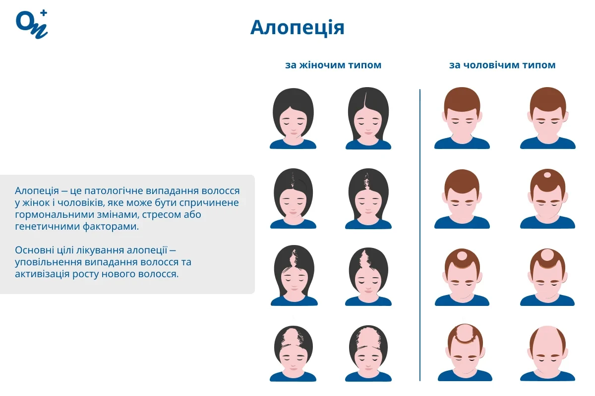 Алопеція