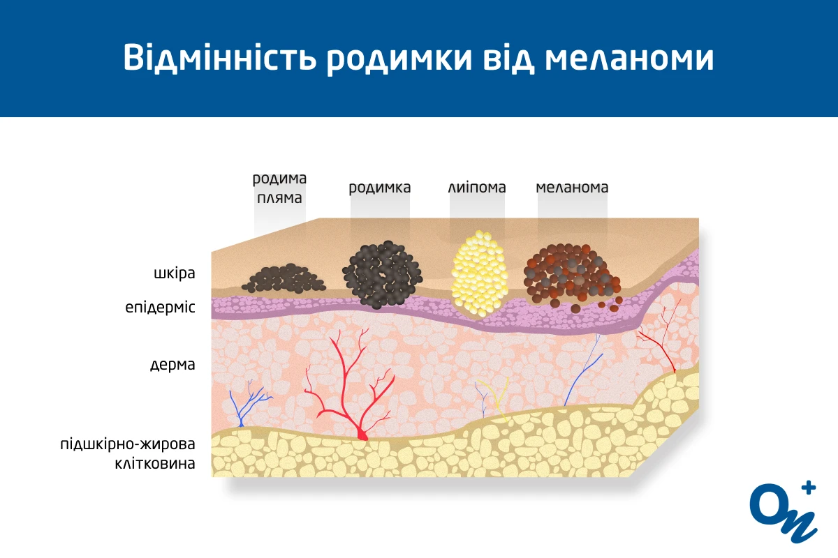 Різниця між невусом, ліпомою і меланомою